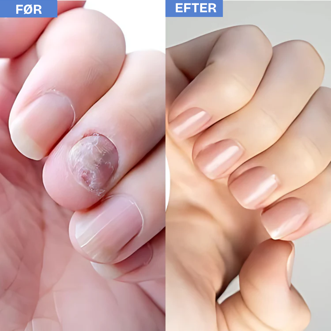 Neglura Pro™ | Fjern neglesvamp uden kemi – få rene, sunde negle med bare 7 minutters brug om dagen!