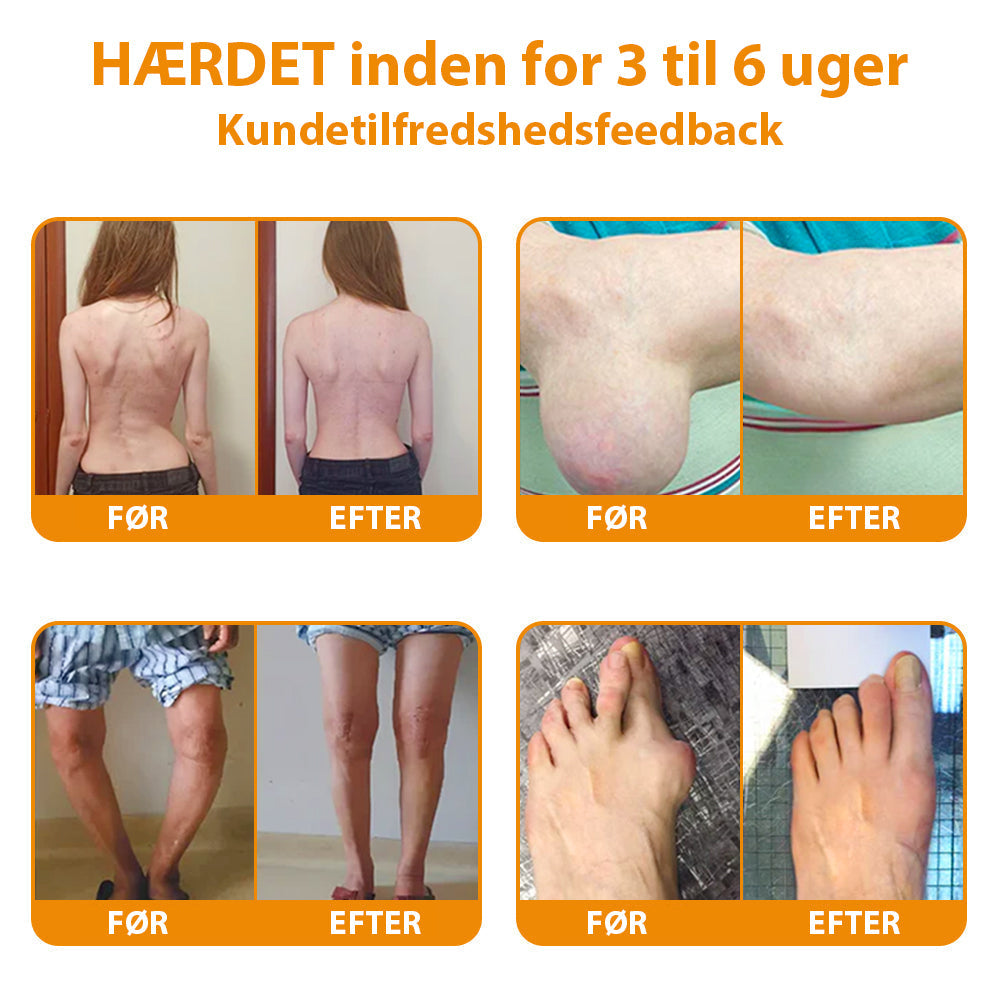 Furzero V3 Pro™ | Bi-gift smertelindrende og ledhelende creme. Anbefalet af Dansk Ortopædisk Selskab (DOS)!