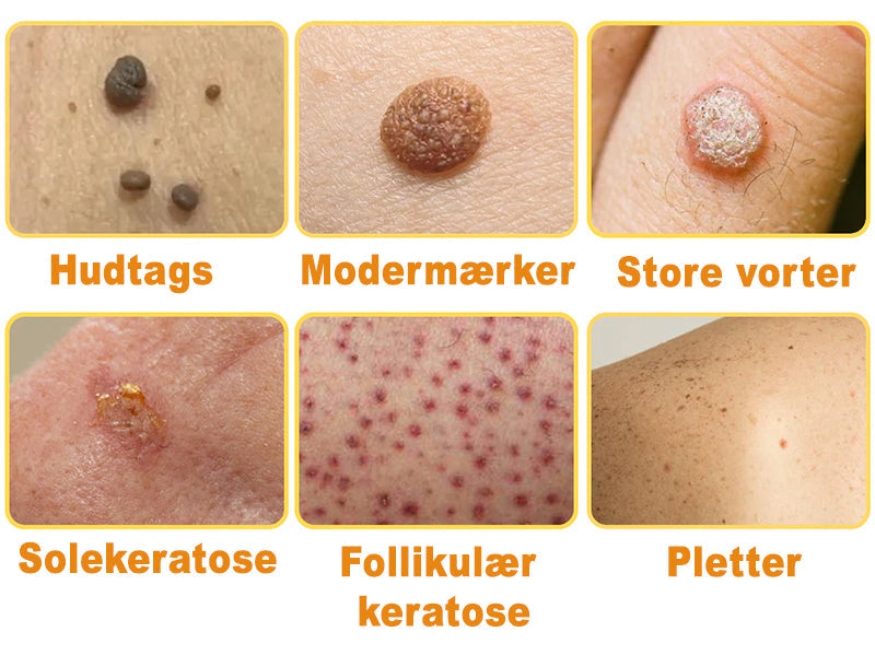 Apivita™ Bikemadsmiddel Behandling Creme - Farvel til hudimperfektioner – Hej til glattere, klarere hud!
