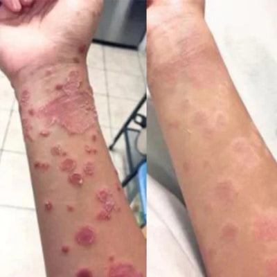 PsoriaFri Spray™ | Tag kontrol over din psoriasis. Hurtig og nem lindring med spray!