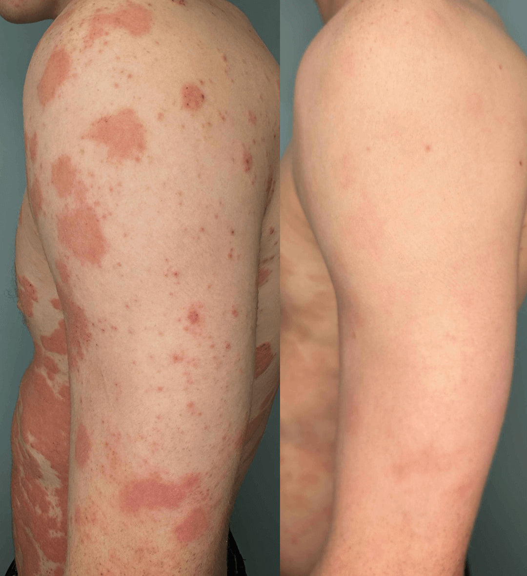 PsoriaFri Spray™ | Tag kontrol over din psoriasis. Hurtig og nem lindring med spray!