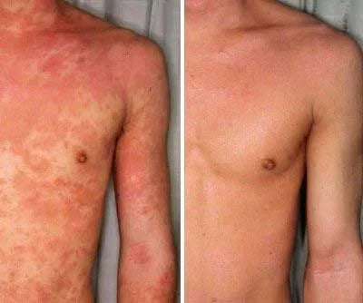 PsoriaFri Spray™ | Tag kontrol over din psoriasis. Hurtig og nem lindring med spray!