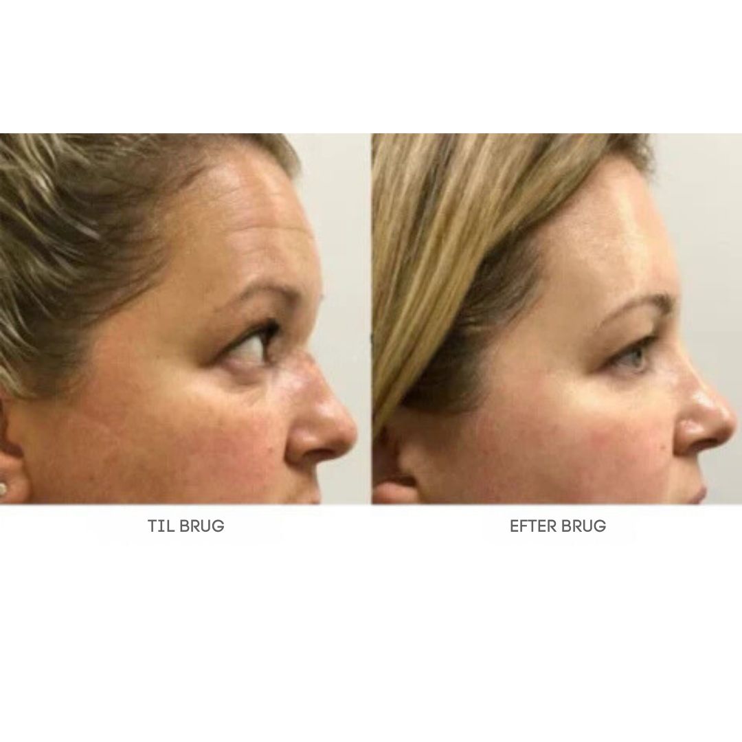 GlowLift™ | Fjern rynker og få en strålende, ungdommelig hud med vores Botox-ansigtsserum – stimulerer cellefornyelse og vender alderen uden nåle