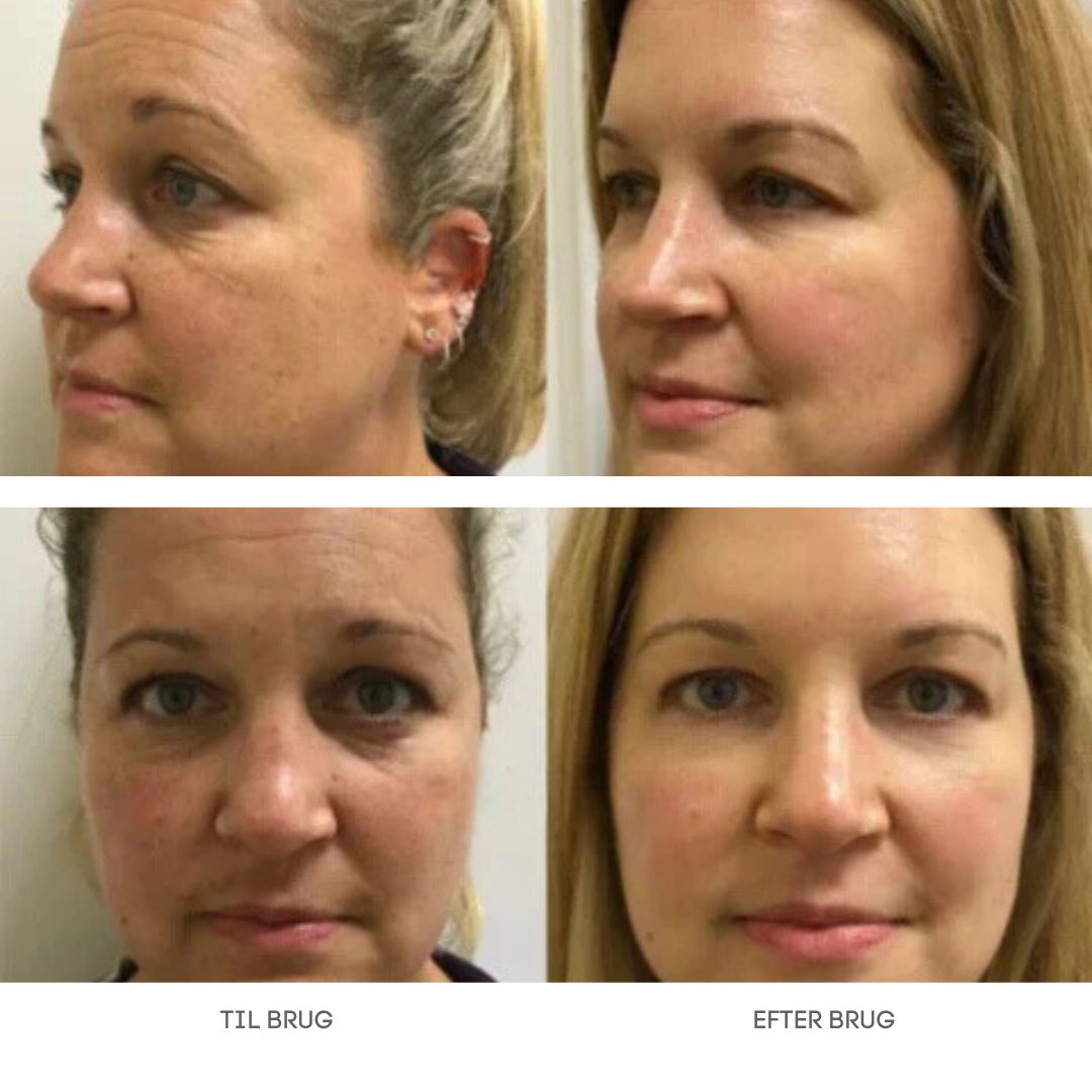 GlowLift™ | Fjern rynker og få en strålende, ungdommelig hud med vores Botox-ansigtsserum – stimulerer cellefornyelse og vender alderen uden nåle