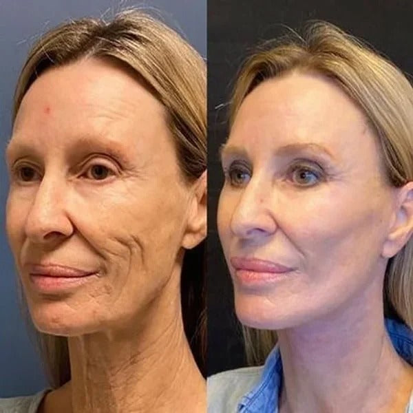 GlowLift™ | Fjern rynker og få en strålende, ungdommelig hud med vores Botox-ansigtsserum – stimulerer cellefornyelse og vender alderen uden nåle