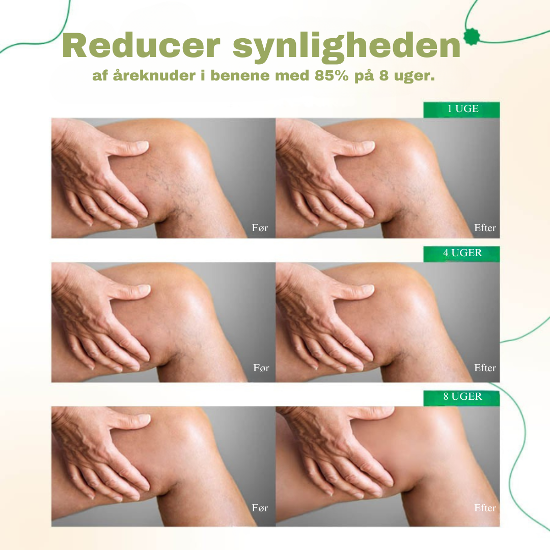 VeinEase Pro™ | Sig farvel til åreknuder og hævelser - få glatte, selvsikre ben på bare 2-4 uger