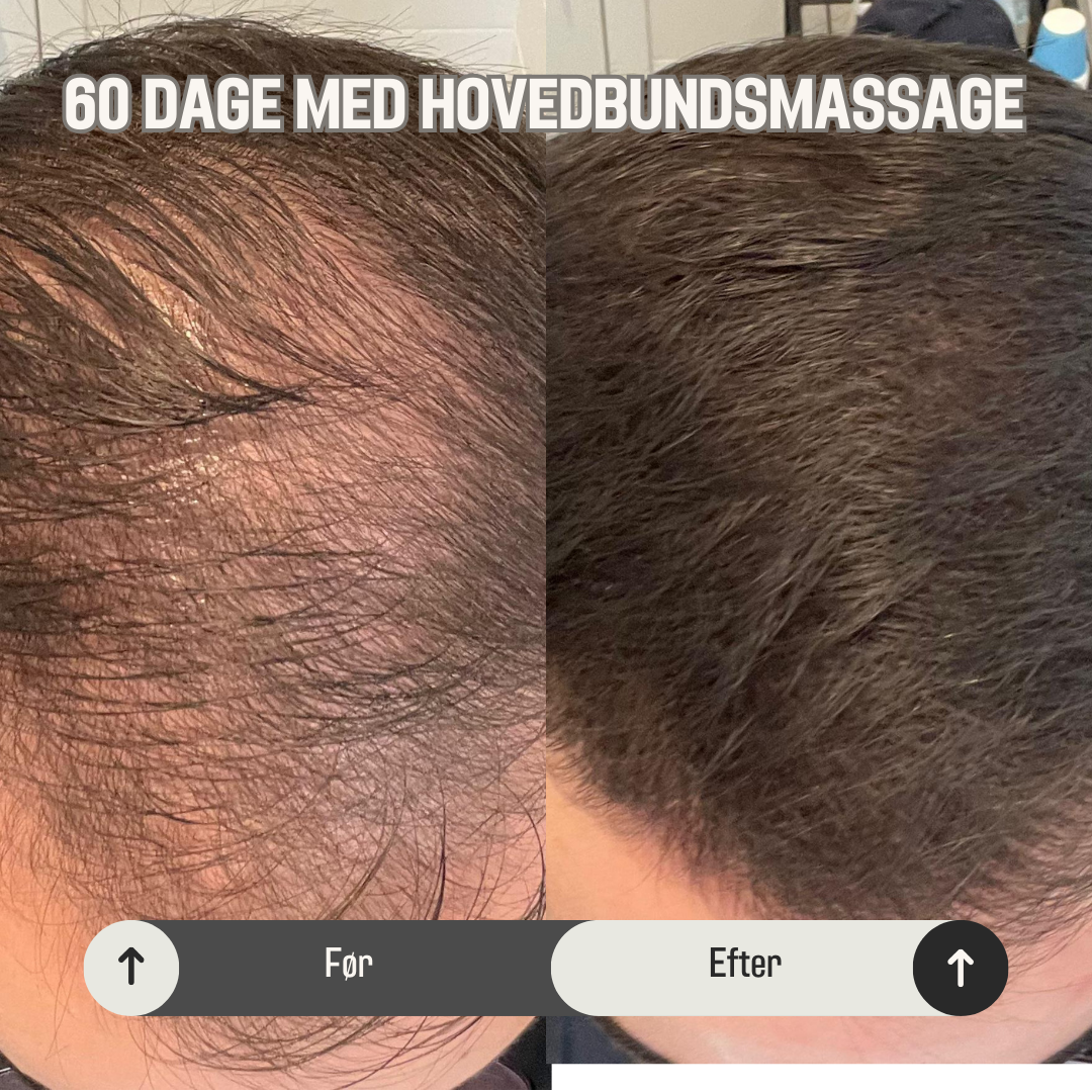 ScalpRevive™ | Forny din hovedbund og fremme hårvækst – den ultimative massageoplevelse for sundere, tykkere hår!