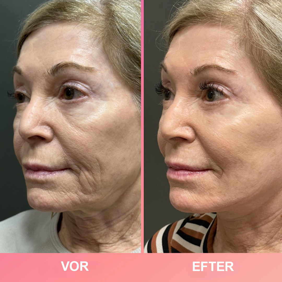 RevitaSkin™ | Forvandl din hud på sekunder – ungdommelig, strålende glød uden besvær!