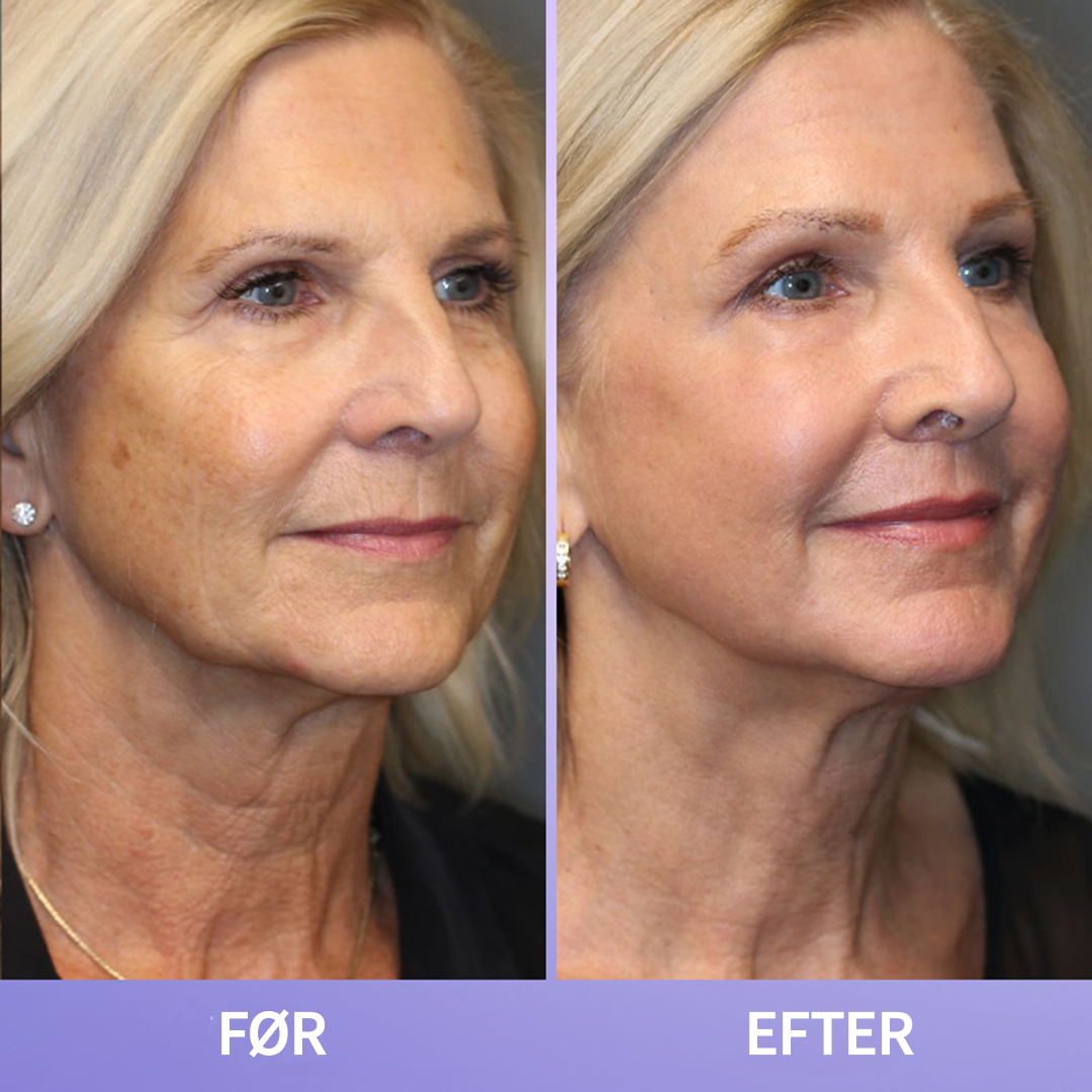 NeckLift™ | Opnå en fastere, glattere hals på få dage – forvandl din hud med naturlige ingredienser!