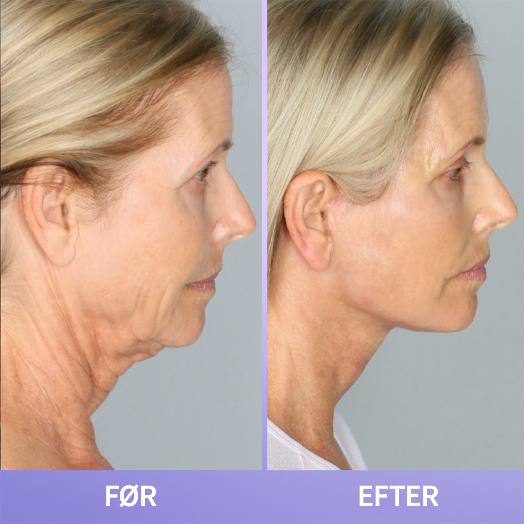 NeckLift™ | Opnå en fastere, glattere hals på få dage – forvandl din hud med naturlige ingredienser!