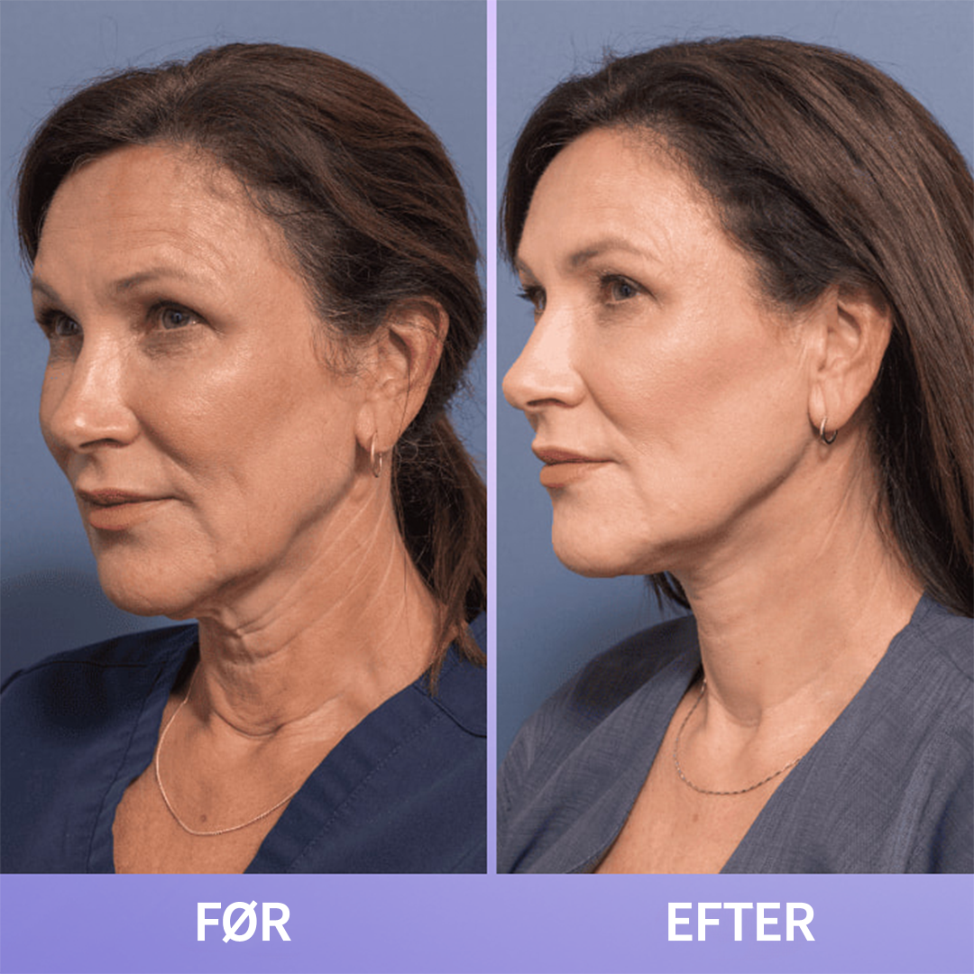 NeckLift™ | Opnå en fastere, glattere hals på få dage – forvandl din hud med naturlige ingredienser!