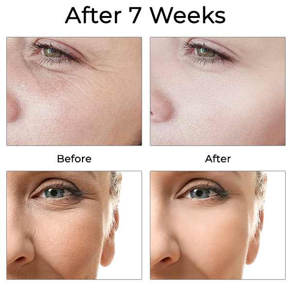 FivFivGo v2 Pro™ Microneedling - siger farvel til rynker og fine linjer, og hej til fast, strålende hud!