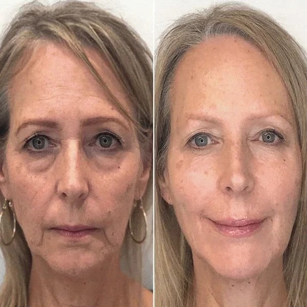 GlowLift™ | Fjern rynker og få en strålende, ungdommelig hud med vores Botox-ansigtsserum – stimulerer cellefornyelse og vender alderen uden nåle