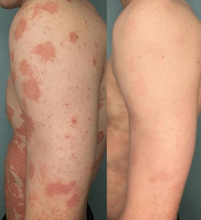 PsoriaFri Spray™ | Tag kontrol over din psoriasis. Hurtig og nem lindring med spray!
