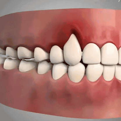 BrightSmile Pro™ | Sig farvel til vigende tandkød, smerter og blødning - genopret tandkødets sundhed på bare 4 dage!
